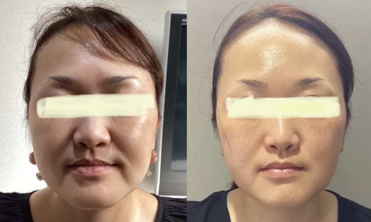 症例1 Before/After