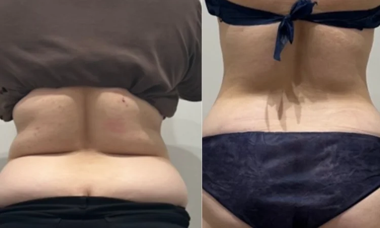 症例4 Before/After